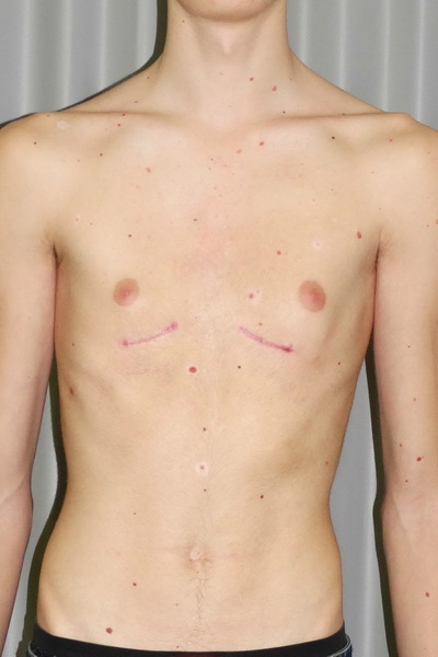 Вогнутая грудная клетка - ВДГК       3 степени, асимметричная правосторонняя форма,   синдром Марфана