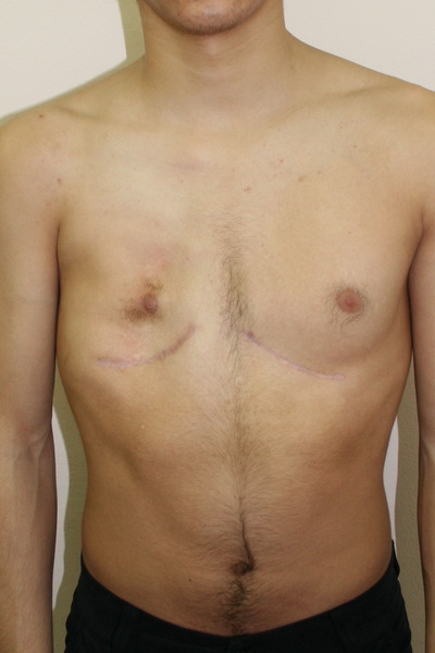 Аплазия (отсутствие) большой грудной мышцы справа и воронкообразная деформация грудной клетки 2 степени, симметричной формы