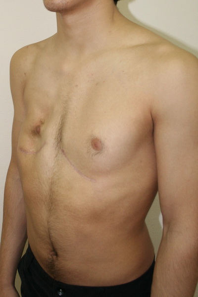 Аплазия (отсутствие) большой грудной мышцы справа и воронкообразная деформация грудной клетки 2 степени, симметричной формы