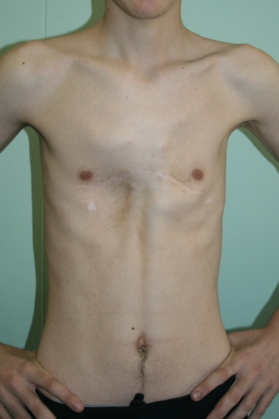 Рецидив воронкообразной деформации грудной клетки после операции Палтиа
