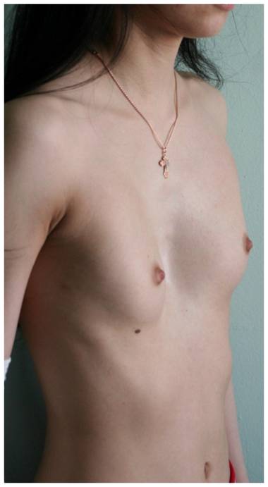 У многих девушек с воронкообразной деформацией грудной клетки (около 80%) о