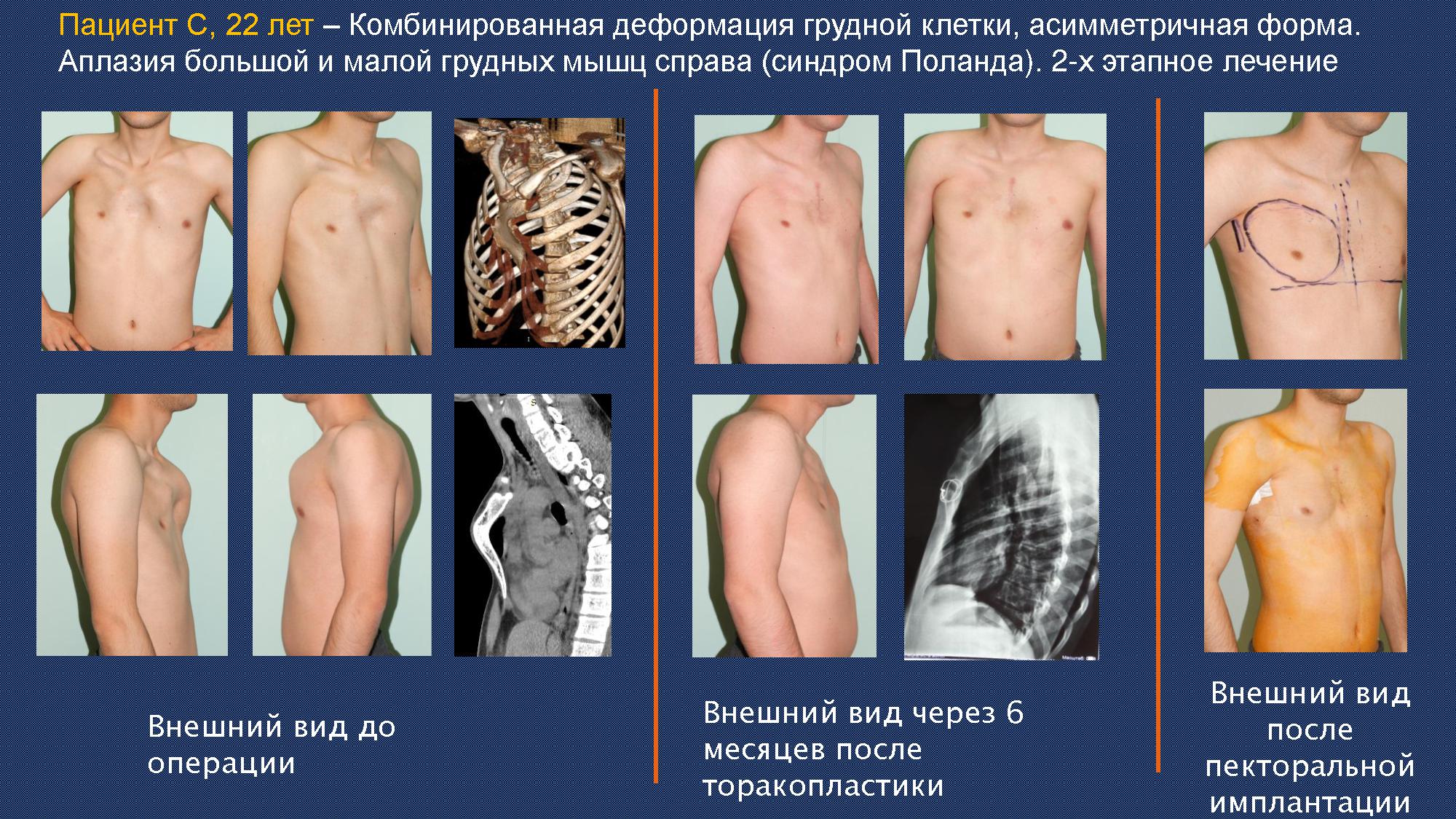 Хирургия при комбинированной деформации груди Хирургия воронкообразной деформации грудной клетки