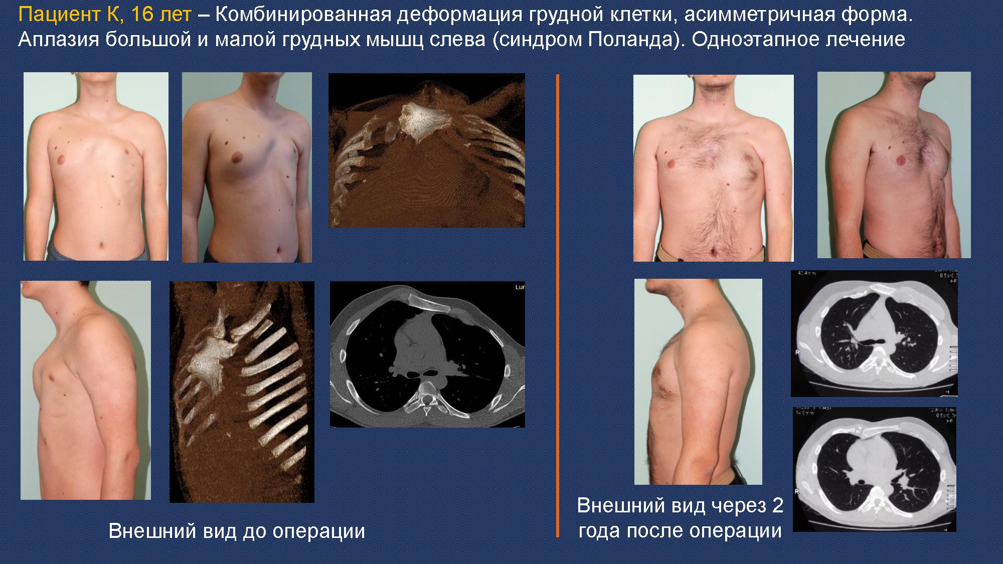 Хирургия при комбинированной деформации груди Хирургия воронкообразной деформации грудной клетки