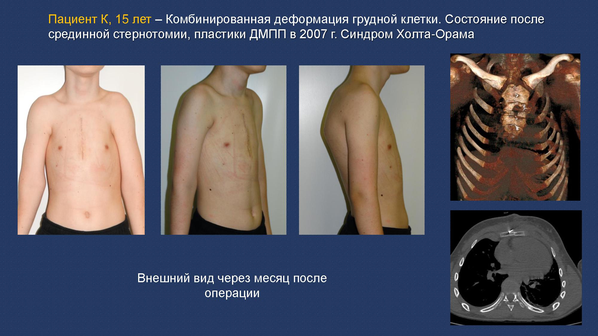 Хирургия при комбинированной деформации груди Хирургия воронкообразной деформации грудной клетки